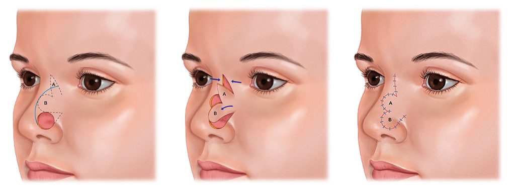 Facial Cancer Reconstruction Nose