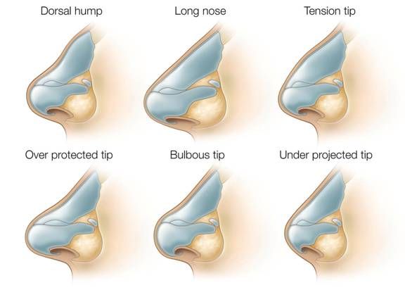 Nose Types