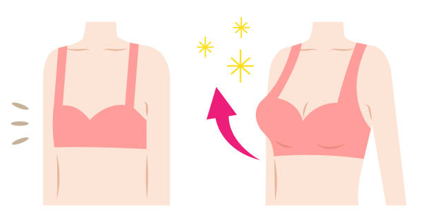 Breast Augmentation