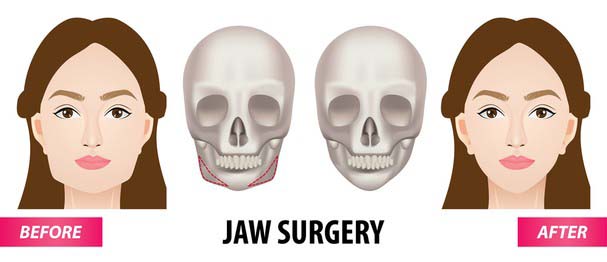 Orthognathic Surgery